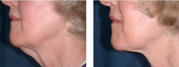 Before And After Photos Mountain View - Face and Neck Lifting Image 14