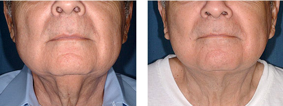 Before And After Photos Mountain View - Face and Neck Lifting Image 15