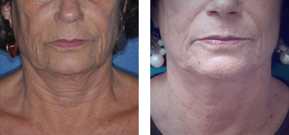 Before And After Photos Mountain View - Face and Neck Lifting Image 17