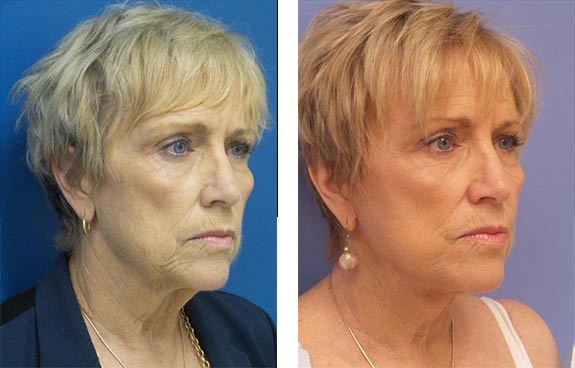 Before And After Photos Mountain View - Face and Neck Lifting Image 17