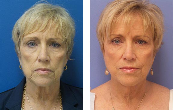 Before And After Photos Mountain View - Face and Neck Lifting Image 17