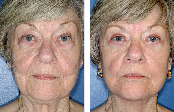 Before And After Photos Mountain View - Face and Neck Lifting Image 02