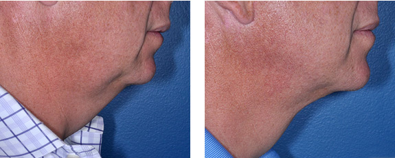 Before And After Photos Mountain View - Face and Neck Lifting Image 03