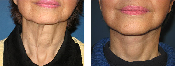 Before And After Photos Mountain View - Face and Neck Lifting Image 04