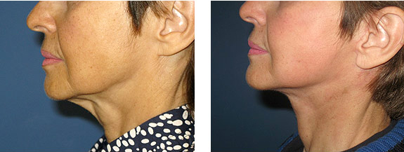 Before And After Photos Mountain View - Face and Neck Lifting Image 05