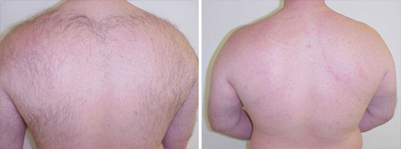 Before And After Photos Mountain View - LightSheer® DUET™ Laser Hair Removal 01
