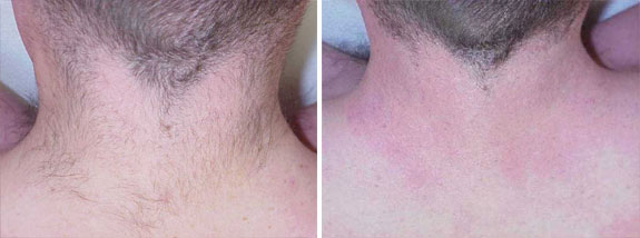 Before And After Photos Mountain View - LightSheer® DUET™ Laser Hair Removal 02