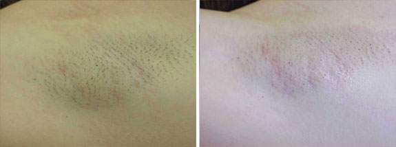 Before And After Photos Mountain View - LightSheer® DUET™ Laser Hair Removal 03