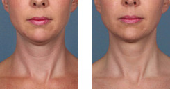 Before And After Photos Kybella Mountain View - miraDry 01