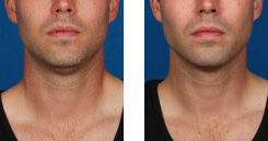 Before And After Photos Kybella Mountain View - miraDry Image 03