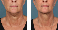Before And After Photos Kybella Mountain View - miraDry Image 04