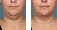 Before And After Photos Kybella Mountain View - miraDry Image 05