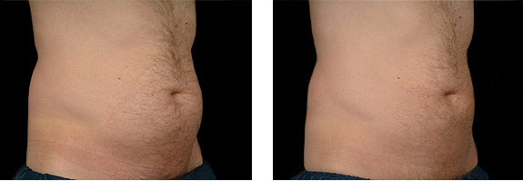 Before And After Photos Mountain View - CoolSculpting Image 05
