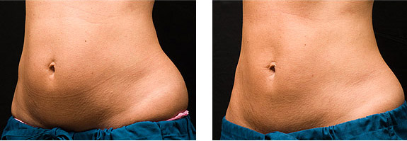 Before And After Photos Mountain View - CoolSculpting Image 04