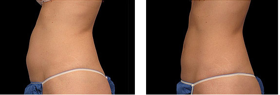 Before And After Photos Mountain View - CoolSculpting Image 03
