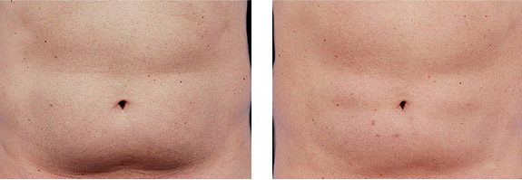 Before And After Photos Mountain View - CoolSculpting Image 02