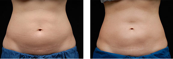 Before And After Photos Mountain View - CoolSculpting Image 01