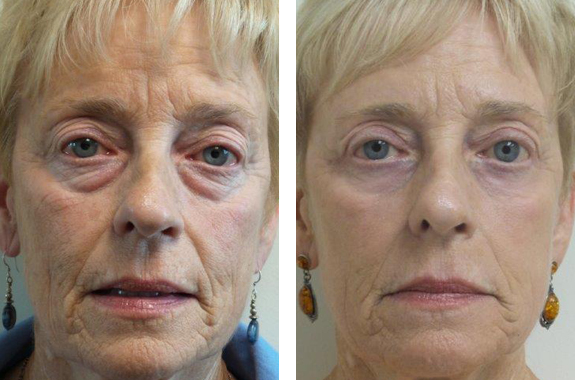 Before And After Photos Mountain View - Laser Resurfacing Image 15