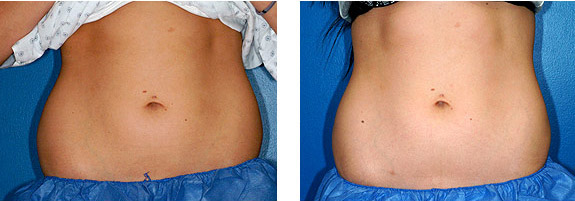 Before And After Photos Mountain View - CoolSculpting Image 13