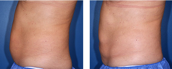 Before And After Photos Mountain View - CoolSculpting Image 12