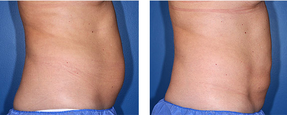 Before And After Photos Mountain View - CoolSculpting Image 11