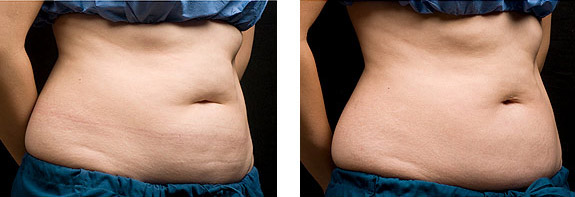 Before And After Photos Mountain View - CoolSculpting Image 09
