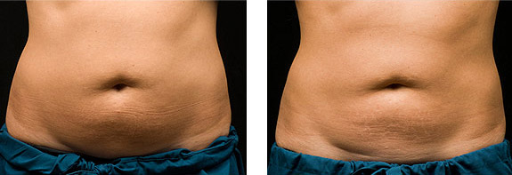 Before And After Photos Mountain View - CoolSculpting Image 07