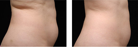 Before And After Photos Mountain View - CoolSculpting Image 06