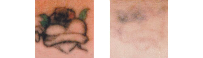 Before And After Photos Mountain View - Before After Case 04