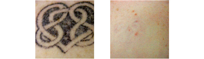 Before And After Photos Mountain View - Before After Case 01