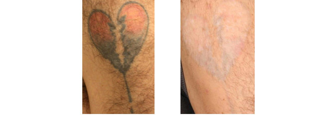 Before And After Photos Mountain View - Before After Case 09