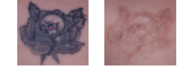 Before And After Photos Mountain View - Before After Case 14