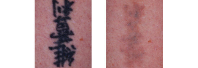 Before And After Photos Mountain View - Before After Case 15