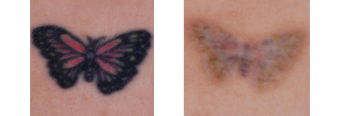 Before And After Photos Mountain View - Before After Case 18