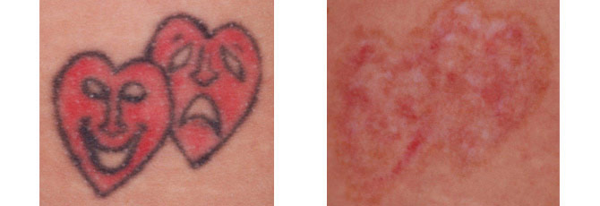 Before And After Photos Mountain View - Before After Case 19