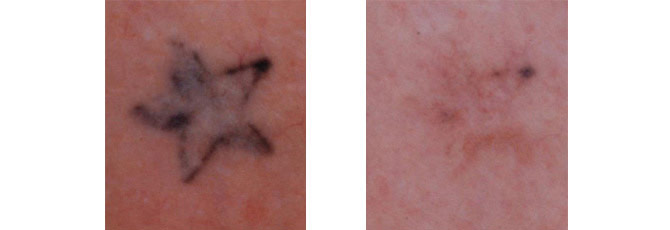 Before And After Photos Mountain View - Before After Case 20