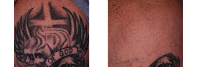 Before And After Photos Mountain View - Before After Case 22