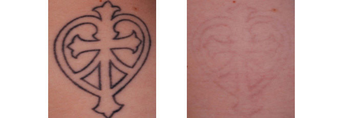 Before And After Photos Mountain View - Before After Case 24