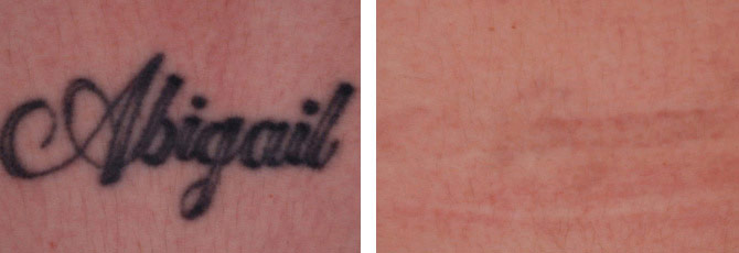 Before And After Photos Mountain View - Before After Case 25