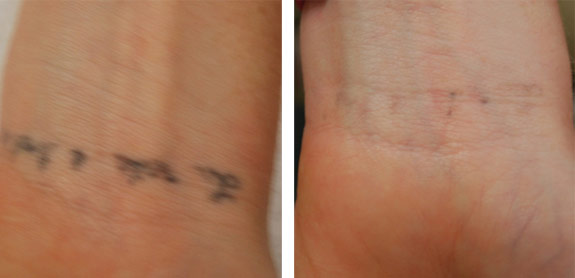 Before And After Photos Mountain View - Before After Case 29