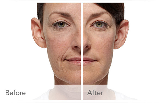 Before And After Photos Mountain View - CoolSculpting Image 03