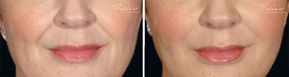 Before And After Photos Mountain View - Restylane®/Perlane®/
JUVÉDERM® XC/Voluma® 02