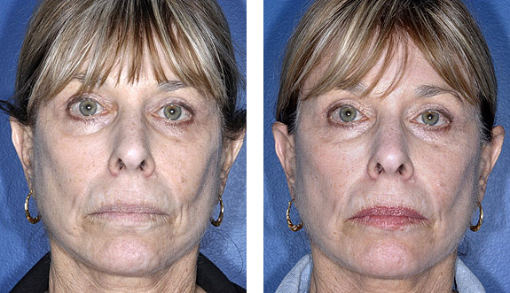 Before And After Photos Mountain View - Sculptra Image 01