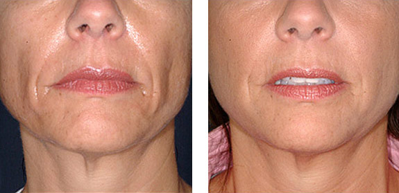 Before And After Photos Mountain View - Sculptra Image 02