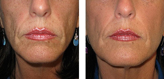 Before And After Photos Mountain View - Sculptra Image 03