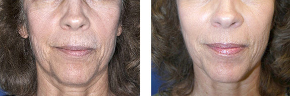 Before And After Photos Mountain View - Sculptra Image 05