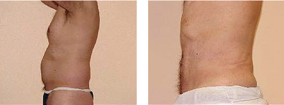 Before And After Photos Mountain View - SmartLipo Image 12