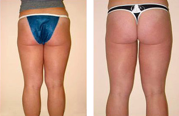 Before And After Photos Mountain View - SmartLipo Image 14