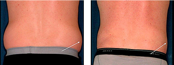 Before And After Photos Mountain View - SmartLipo Image 15