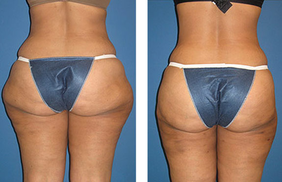 Before And After Photos Mountain View - SmartLipo Image 16